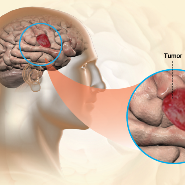 Avances médicos: La lucha contra el glioblastoma, el tipo más agresivo de cáncer cerebral