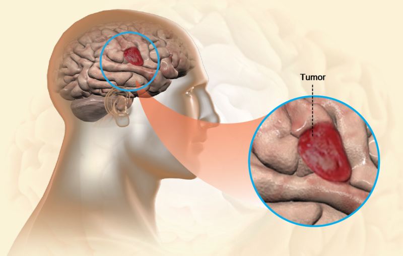 Avances médicos: La lucha contra el glioblastoma, el tipo más agresivo de cáncer cerebral